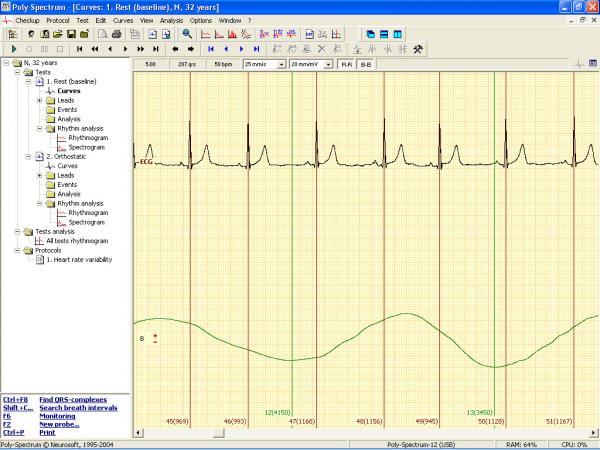 Soft analiza variabiltatii ritmului cardiac POLY-SPECTRUM-RHYTHM/ECG