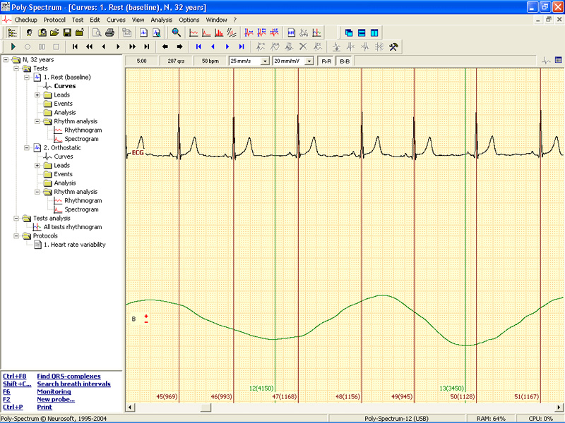 Soft analiza variabiltatii ritmului cardiac POLY-SPECTRUM-RHYTHM/ECG