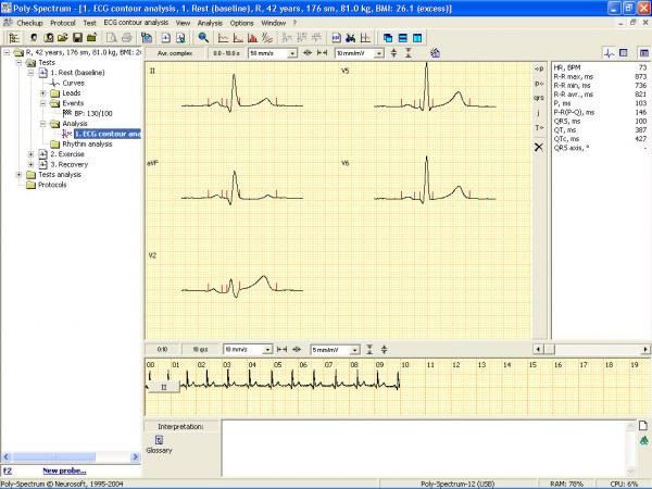 Soft analiza ECG teste de efort POLY-SPECTRUM-ERGO