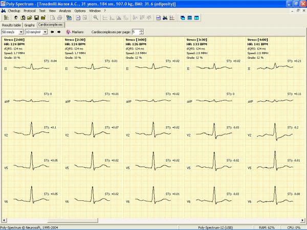 Soft analiza ECG teste de efort POLY-SPECTRUM-ERGO