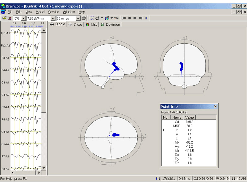 Soft Localizare a focarelor cu activitate patologica BrainLoc 6.0