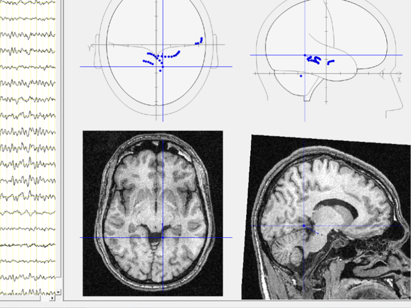 Soft Localizare a focarelor cu activitate patologica BrainLoc 6.0