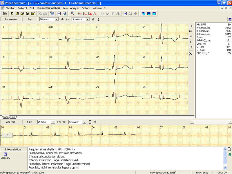 Soft pentru analiza si interpretare trase ECG POLY-SPECTRUM-ANALYSIS