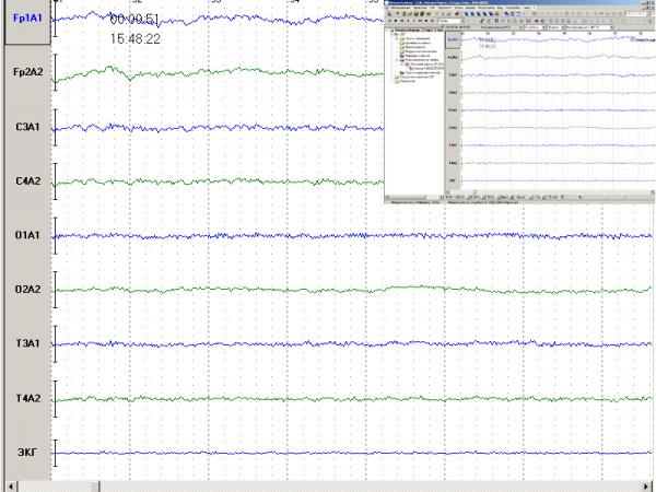 Electroencefalograf uz veterinar NEURON-SPECTRUM-1Vet