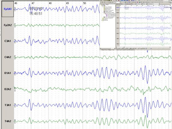 Electroencefalograf uz veterinar NEURON-SPECTRUM-1Vet