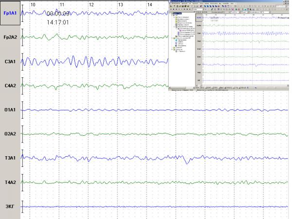 Electroencefalograf uz veterinar NEURON-SPECTRUM-1Vet