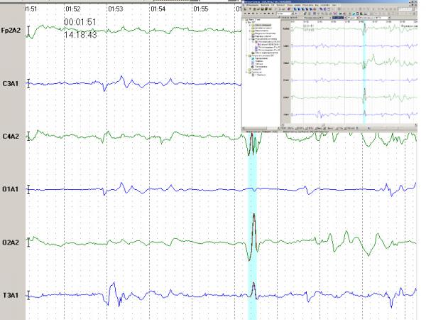 Electroencefalograf uz veterinar NEURON-SPECTRUM-1Vet