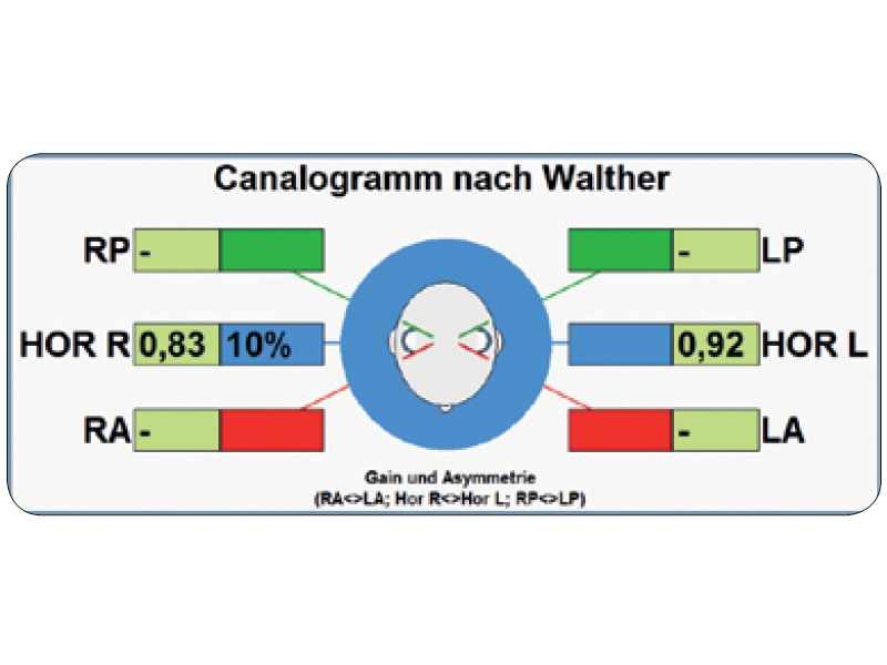 Sistem HIT (Head Impulse Test) 