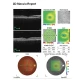 Examinare făcută cu Tomograf in coerenta optica cu Fundus camera integrata VISION 700 